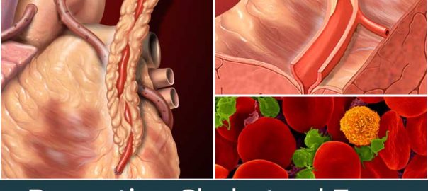 Preventing Cholesterol From Building Up In Your Arteries