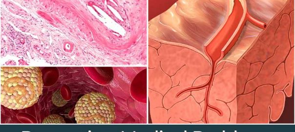 Preventing Medical Problems Caused by Clogged Blood Vessels