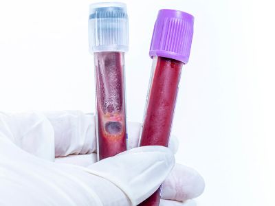 doctor holding 2 vials of blood test