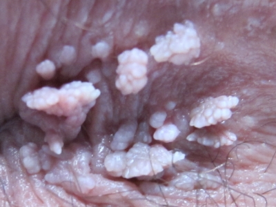 symptoms of HPV Infection