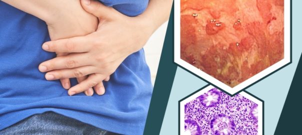 Symptoms and Types of Ulcerative Colitis