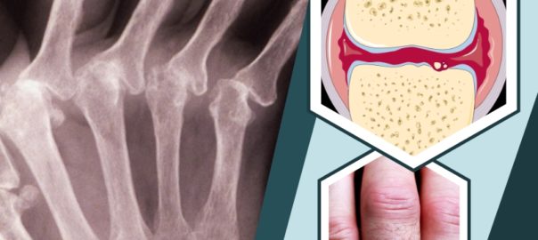 Symptoms of Rheumatoid Arthritis