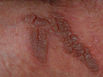 Genital warts around the penis of a man