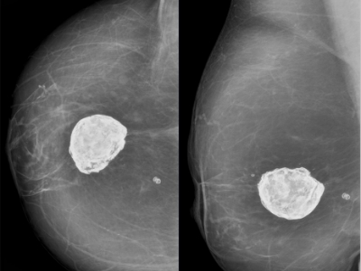 breast cancer on mammogram with big lumps