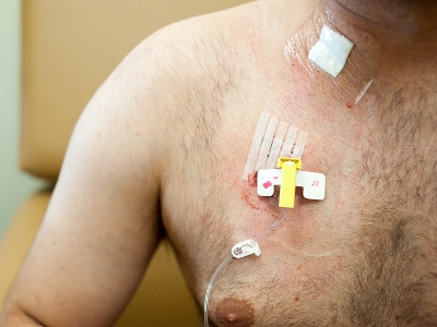 Chemo patient with hairy chest after the theraphy