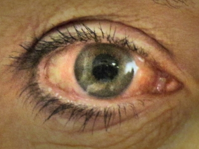 Watery eye of a person with eye problems