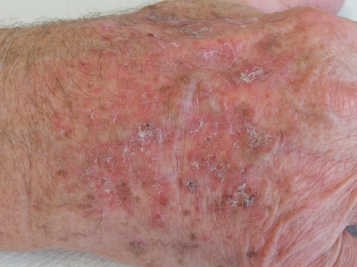 man hands that has Actinic Keratosis clear on the skin