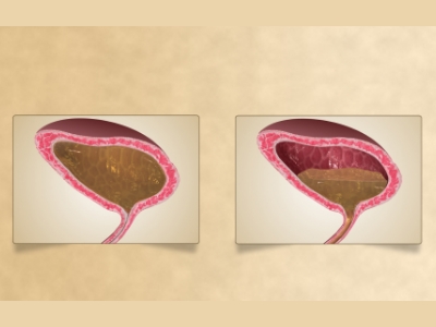 urinary incontinence illustration side by side